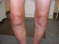 Symptome der Arthrose des Kniegelenks