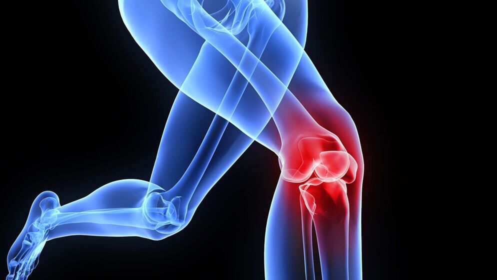 Knieprobleme aufgrund von Arthrose