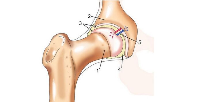 Hüftgelenk und Arthrose